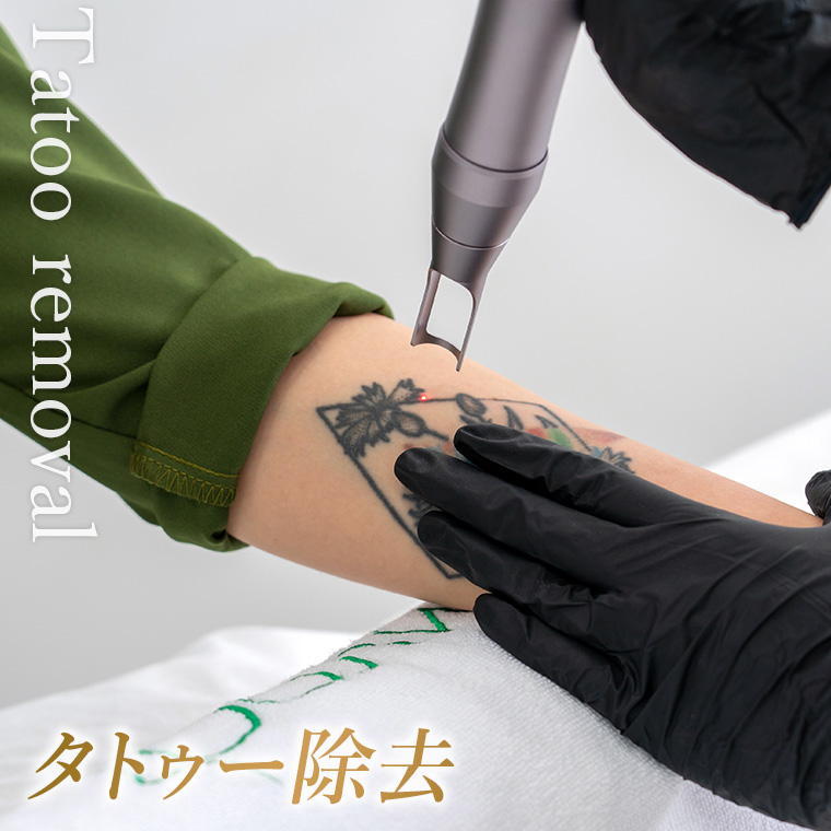 タトゥー除去